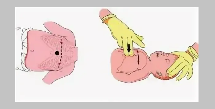 Косвен сърдечен масаж на бебето