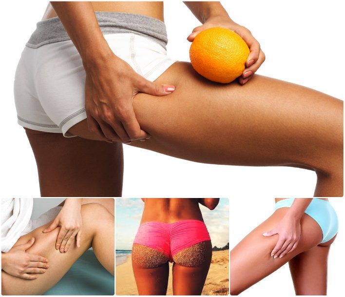 La présence de cellulite sur les jambes