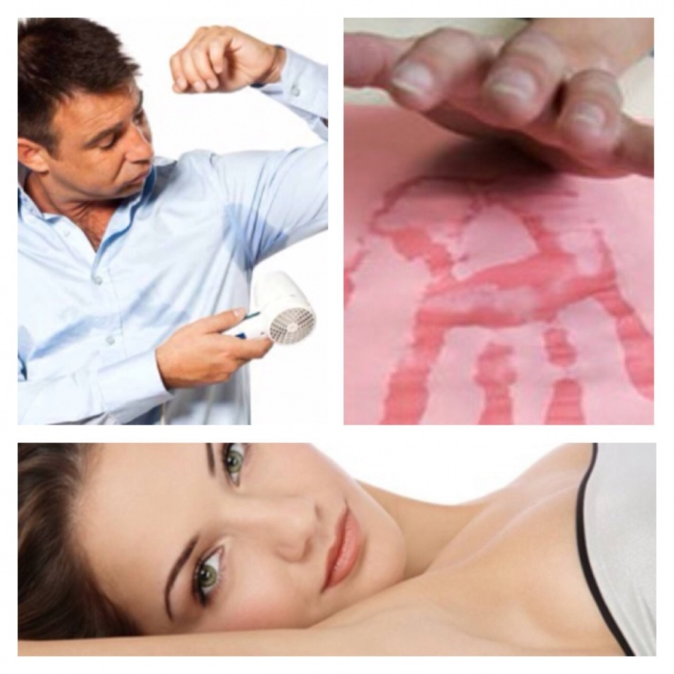 Treatment of hyperhidrosis of the palms and feet of Botox