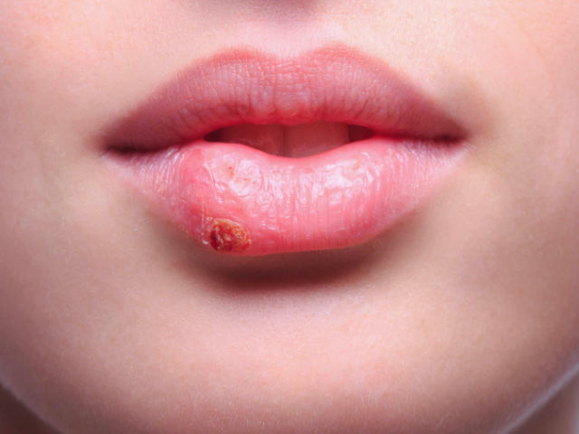 Herpes - is contrast or not? What can not be done with the herpes virus on the lips: is contrast or not with a kiss?