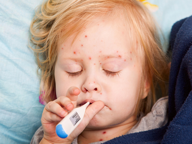 Ošpice pri otrocih: prvi znaki, simptomi, diagnoza, zdravljenje, zapleti, posledice, preprečevanje, cepljenje. Kako se manifestira ošpice, kako izgleda izpuščaj pri otrocih?