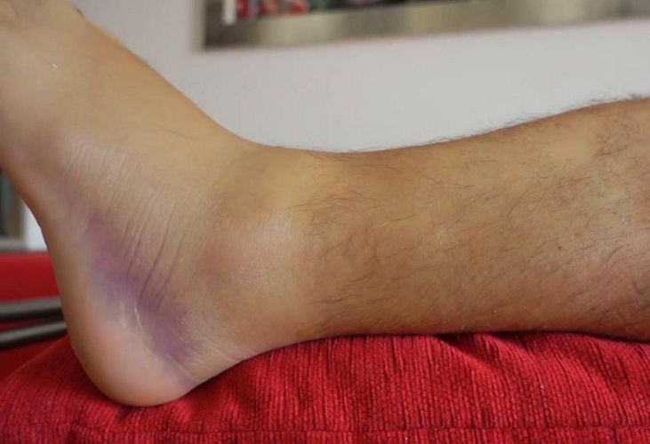 Bruised leg with hematoma