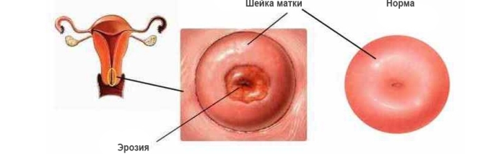 Cervical erosion