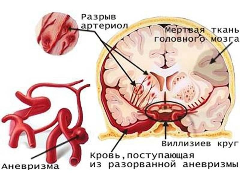 Učinek kajenja na možgane krvnih žil