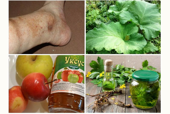Folk remedies for itching varicose veins