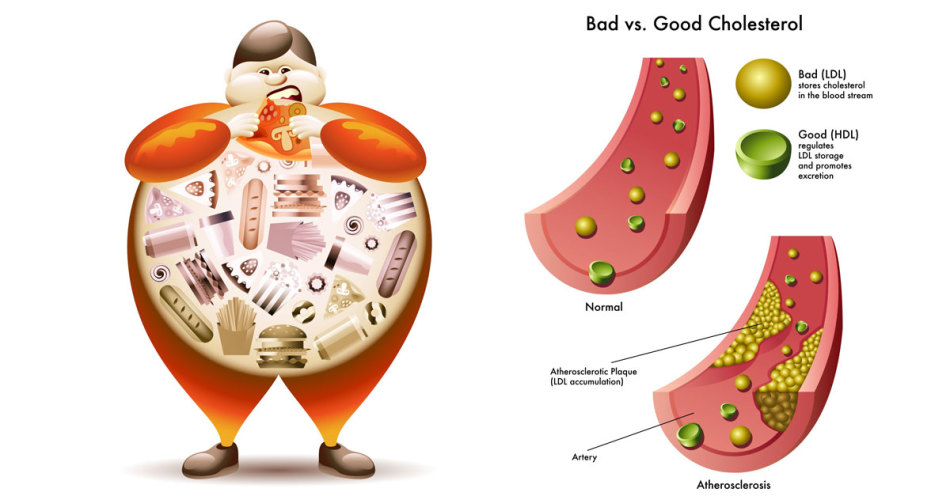 Visok holesterol: simptomi, kaj storiti, kaj se poveča holesterol, kaj je nevarno?