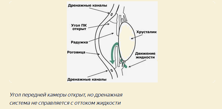La forme ouverte-angle de glaucome