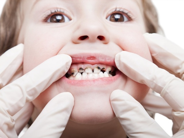 Comment éliminer la plaque sur les dents? Comment éliminer la plaque à la maison?