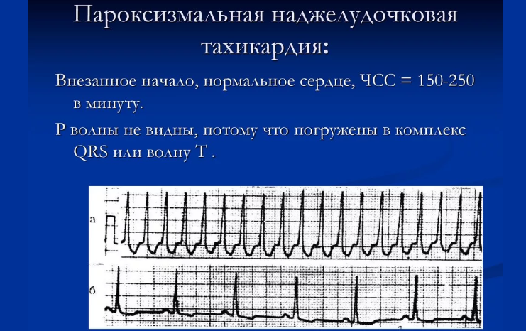 Аритмия