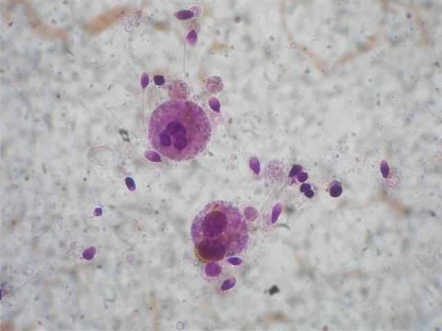 A leukociták számának meghatározásához a spermában, és megkülönböztetni azokat az éretlen spermiumoktól, a leukocitákat festették