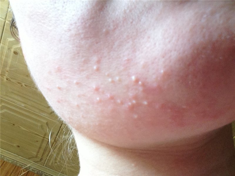 White acne