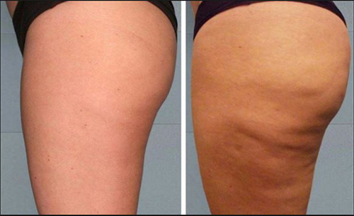 The fight against cellulite