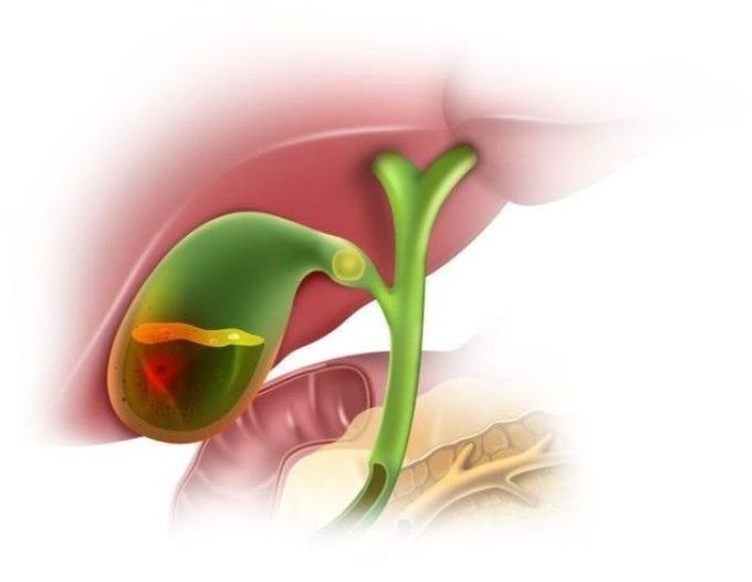 Cholesterol is one of the reasons for the formation of stones in the gall bladder.