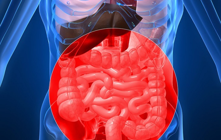 Enteritis akut, kolitis - eksaserbasi