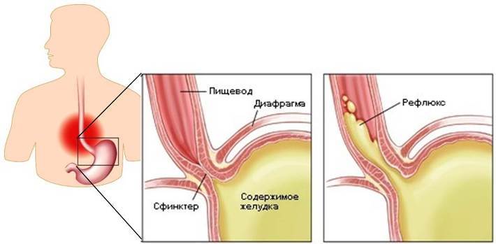 Reflux d'acide