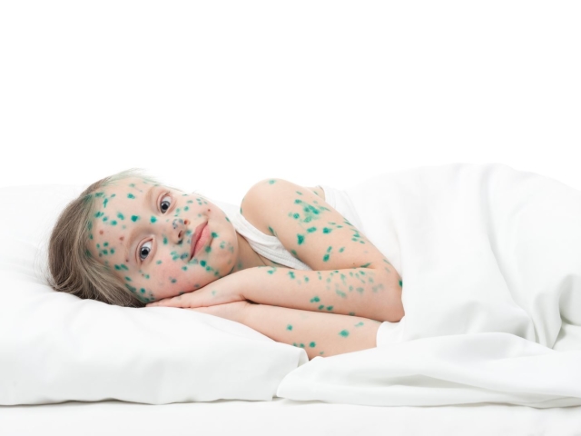 Combien de jours est la période d'incubation, le contraste de la varicelle chez les enfants et les adultes?