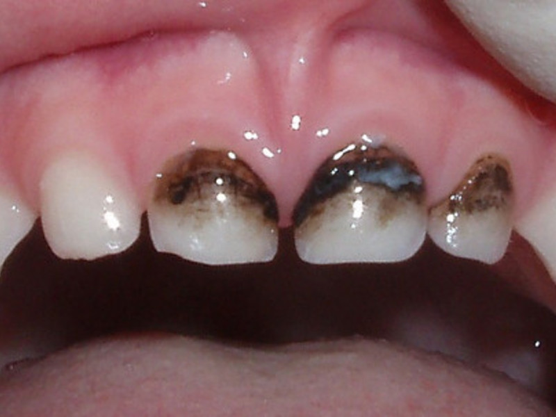 Otroški mlečni zobje, ki jih je prizadel karies