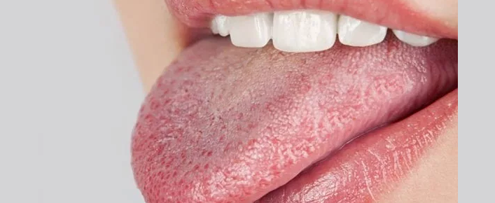 Sedikit lidah putih tanpa serangan pada orang dewasa