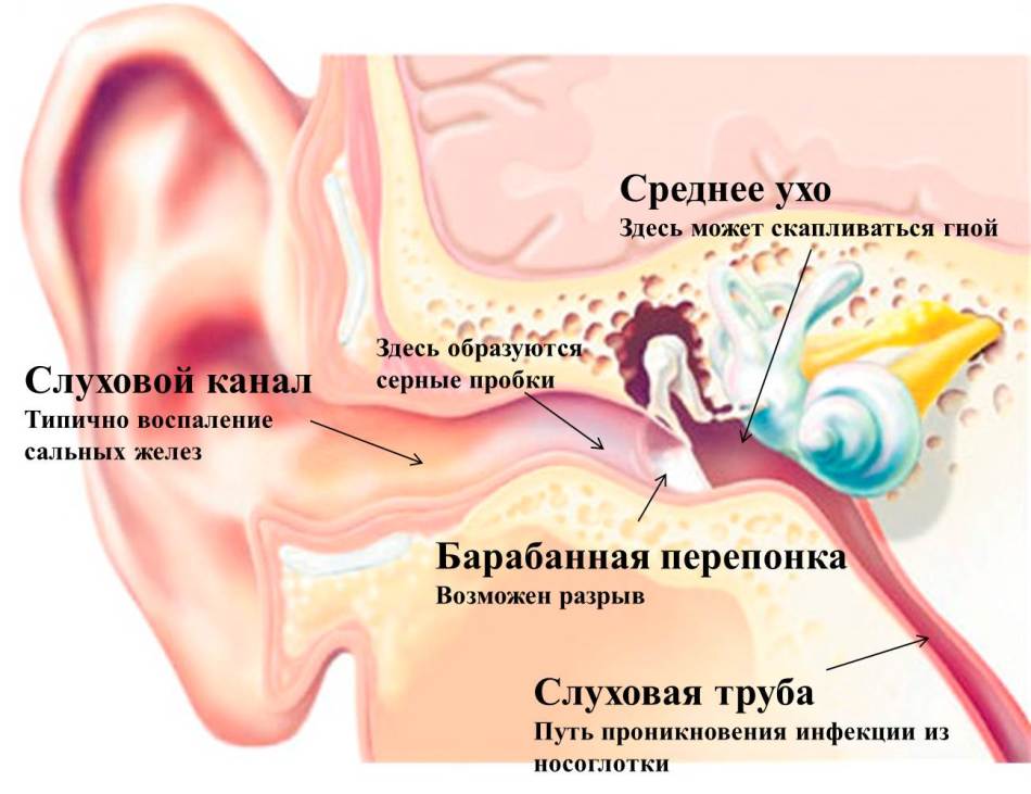 Может ли болеть голова от пробок в ушах
