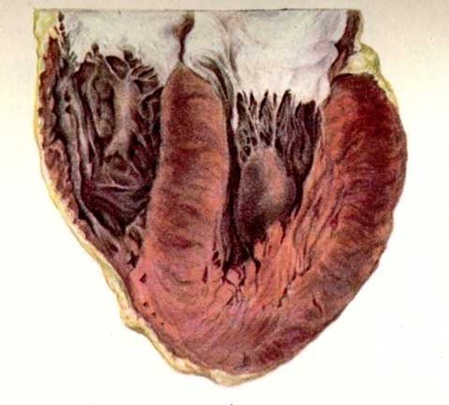 The wall of the left ventricle is hypertrophied
