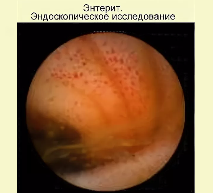 Patogénesis, etiología de la enteritis crónica