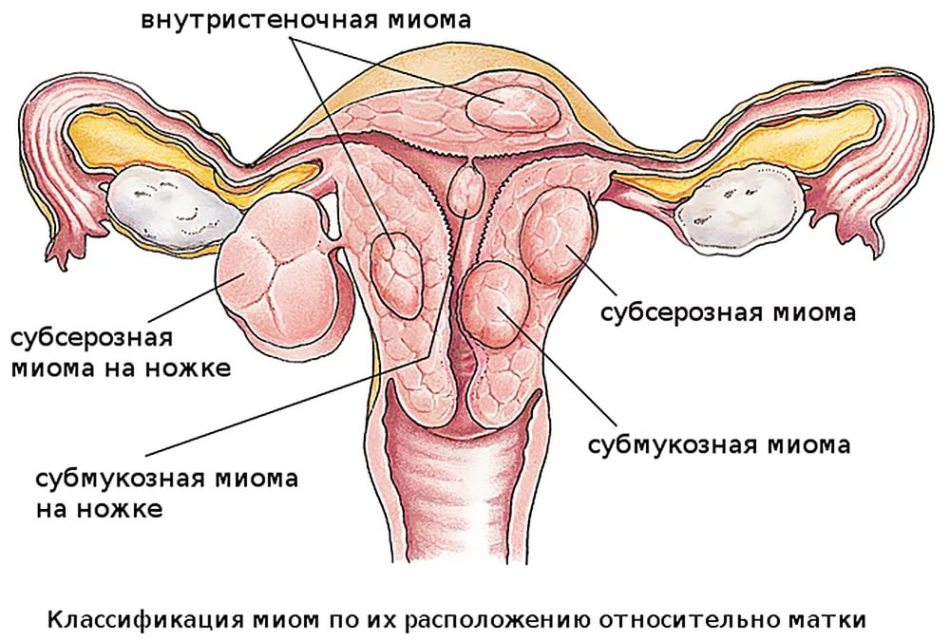 Беременность при субмукозной миоме матки