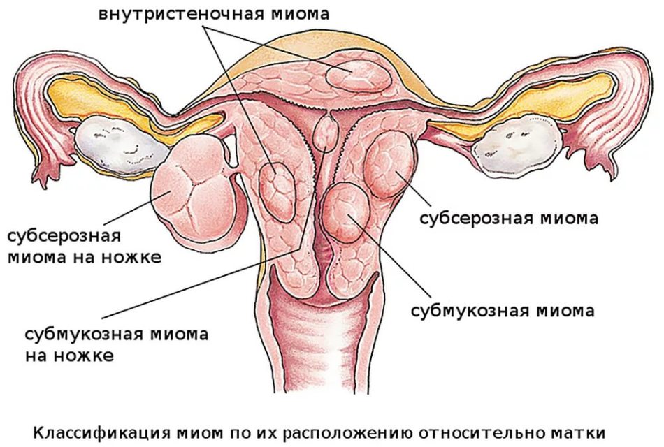 Трудноћа са подмуклом фиброида материце