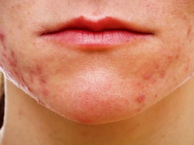 Acne, rashes on the chin: reasons how to get rid of pimples, mistakes in care, how to warn, reviews