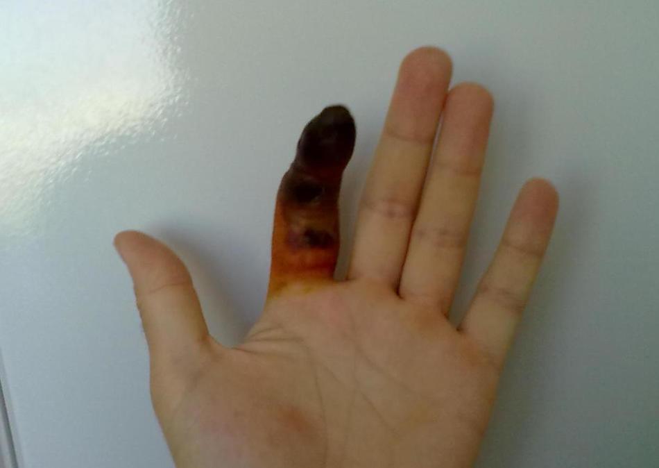 Пандактилит - возможное осложнение абсесса на пальце.