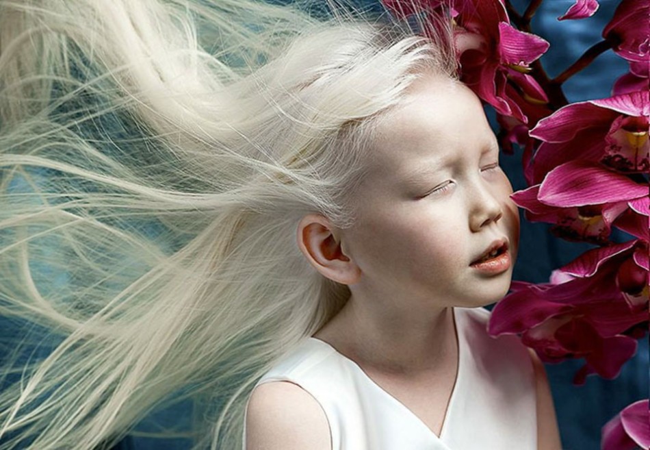 Причины альбинизма