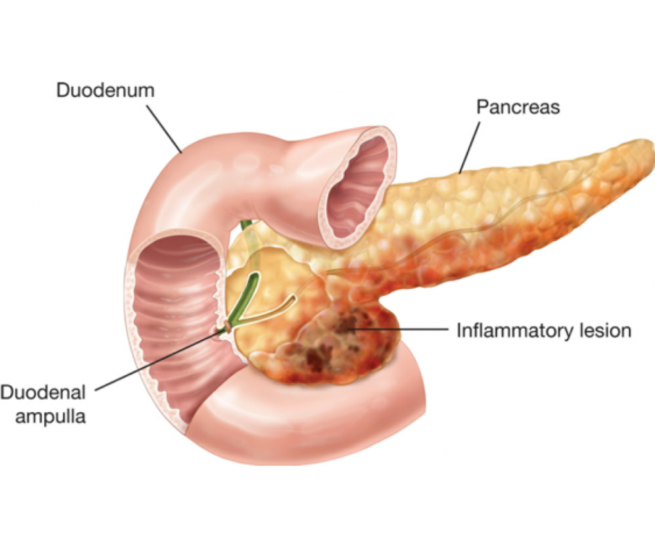 Локализация панкреатита. Диффузные изменения поджелудочной железы что это.
