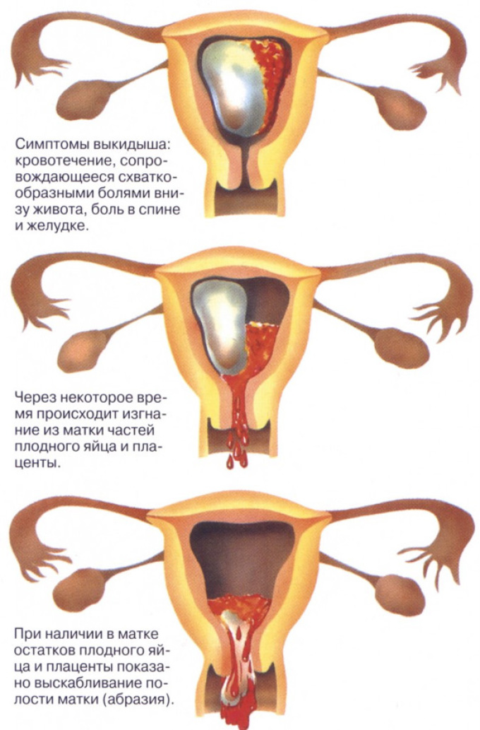 How spontaneous abortion occurs