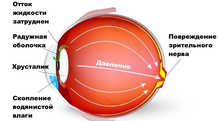 Глаукома глаза