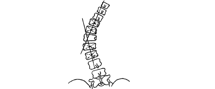 Method for determining the angle of scoliosis