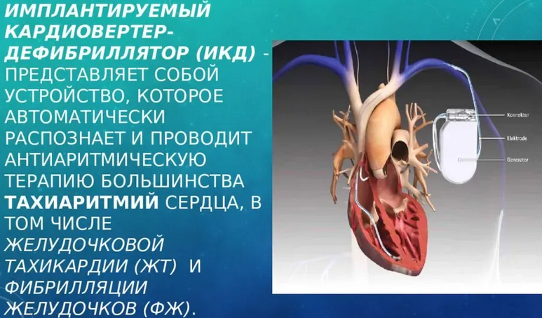 Medical automatic implantable cardiover defibrillator (ICD)