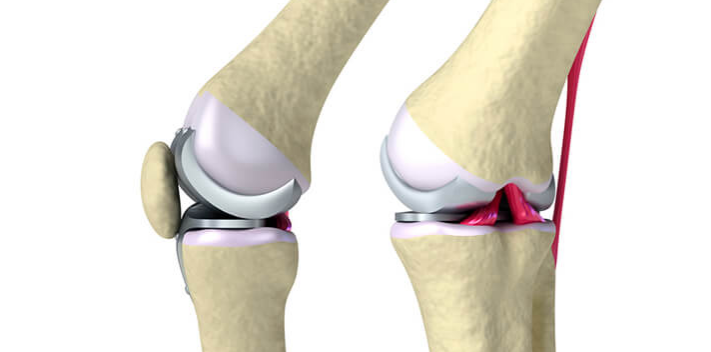 Endoprosthetics of the knee joint