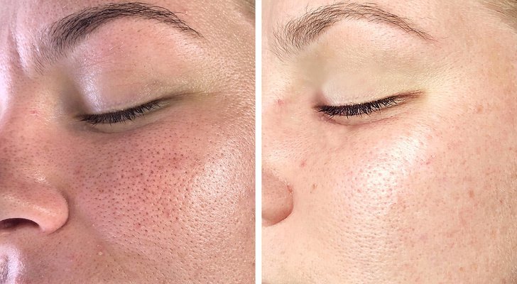 Nettoyage du visage: avant et après