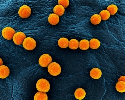 Arany staphylococcus gyermekek, újszülöttek, felnőttek, terhesség alatt: tünetek, okok, fok, kezelés. Hogyan terjedhet ki, lehet -e fertőzni?