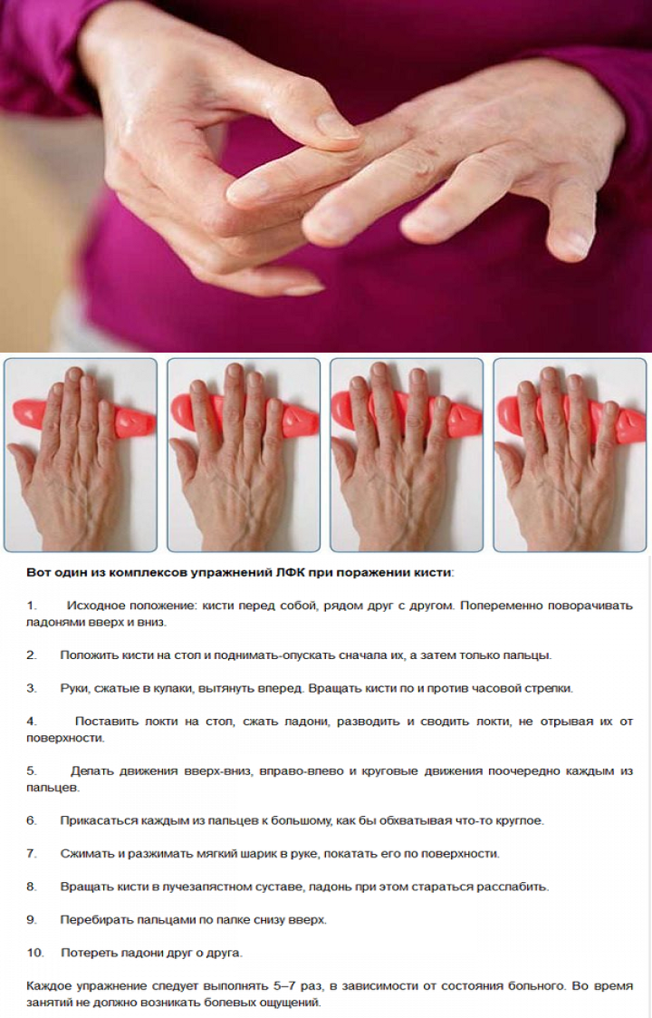 ЛФК на пальцы рук. Лечение артрита рук препараты