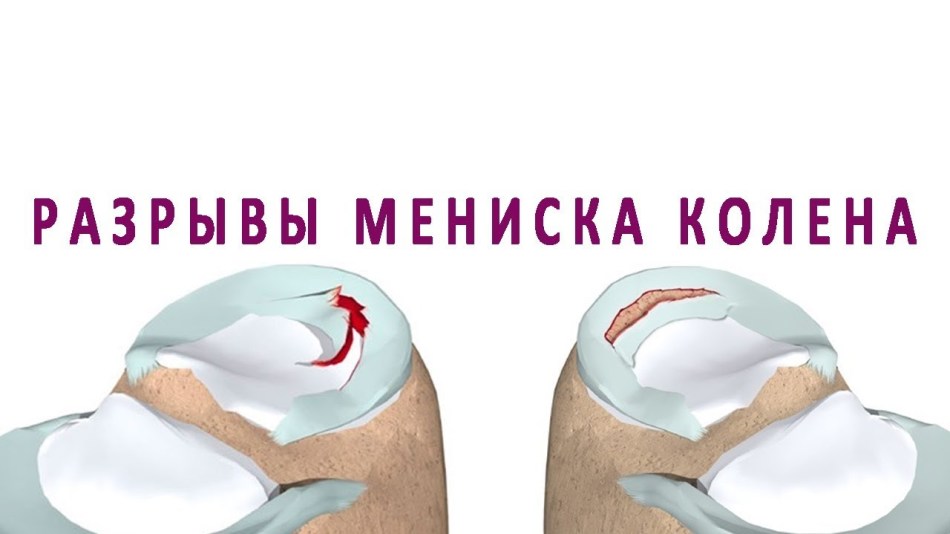 Rupture of the meniscus of the knee