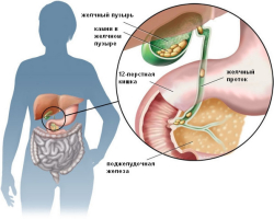 Pierres dans la vésicule biliaire: symptômes, signes, causes. Nutrition et menu pour les pierres dans la vésicule biliaire