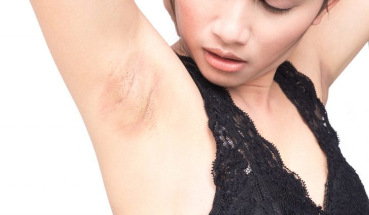 Dark skin of armpits: reasons