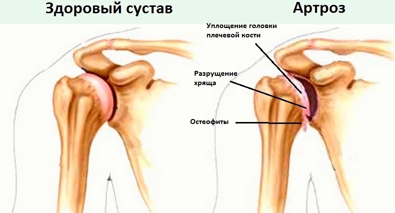 Arthrosis of the ACC with the destruction of cartilage