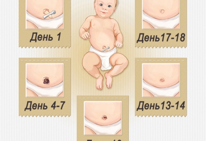 A newborn has a navel: what to do? How to process the navel in a newborn? Why is the navel in newborns wet and blood?