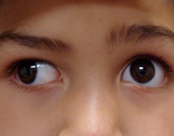 Ребенок косит глазки. Косоглазие. Расходящееся косоглазие. Косоглазие у детей. Расходяшие косрюоглазия.
