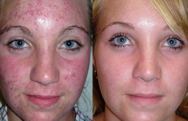 Traitement de l'acné métronidazole: photo avant et après
