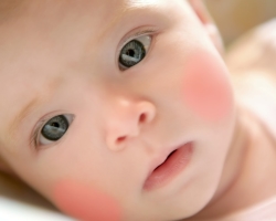 Foltok és kiütések a gyermek arcán és testén: piros, barna, fehér: okok és kezelés