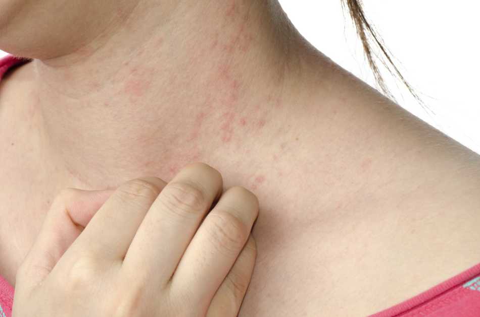 Аллергическая сыпь на коже
