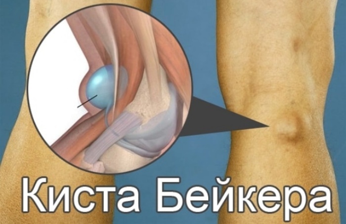 Baker's cyst of the knee joint