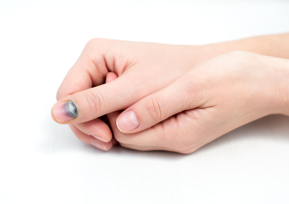 Деформация ногтя после травмы